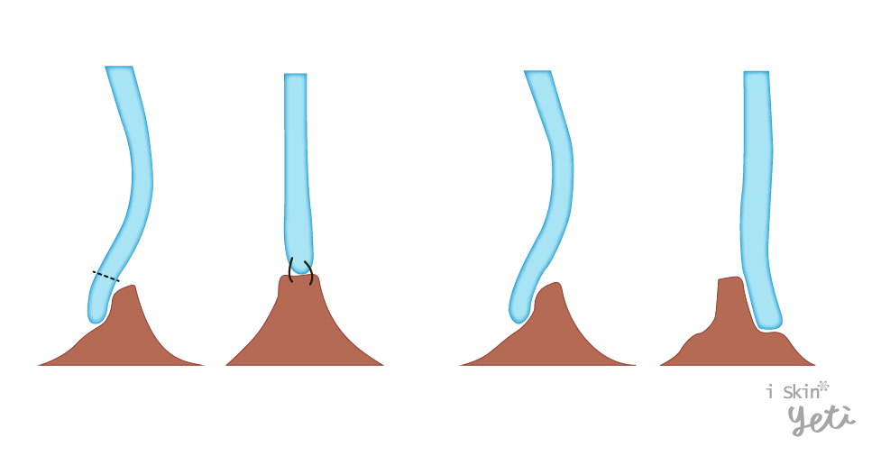 鼻中隔旋轉繞道術(Swinging door maneuver)是結構重建的技術，即將尾端鼻中隔軟骨由脫垂的一側。